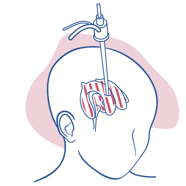 Imagem que ilustra um procedimento de Neuroendoscopia.