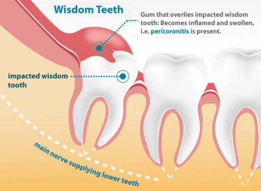 WISDOM TEETH