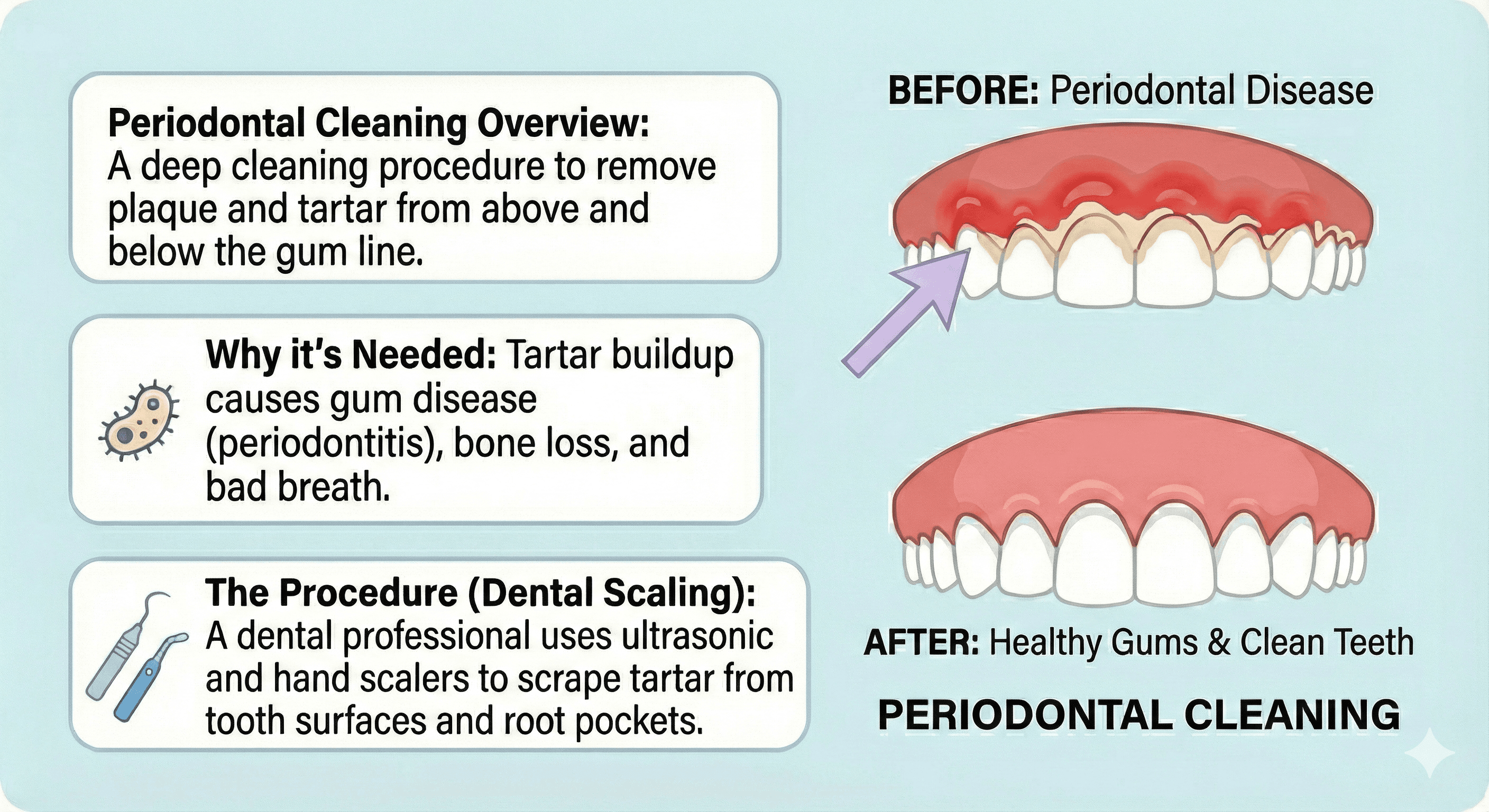 Infographic of a periodontal cleaning in North York, ON at Sovrle Dental Clinic describing an overview of the procedure, causes of swollen gums, and how the procedure is performed | Top rated dentist in North York, ON at Sovrle Dental Clinic