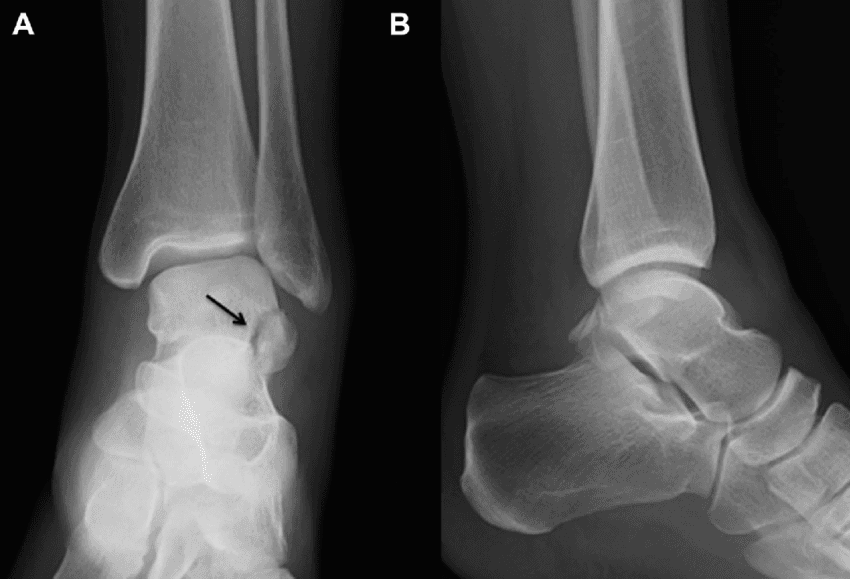 x-ray of ankle sprain