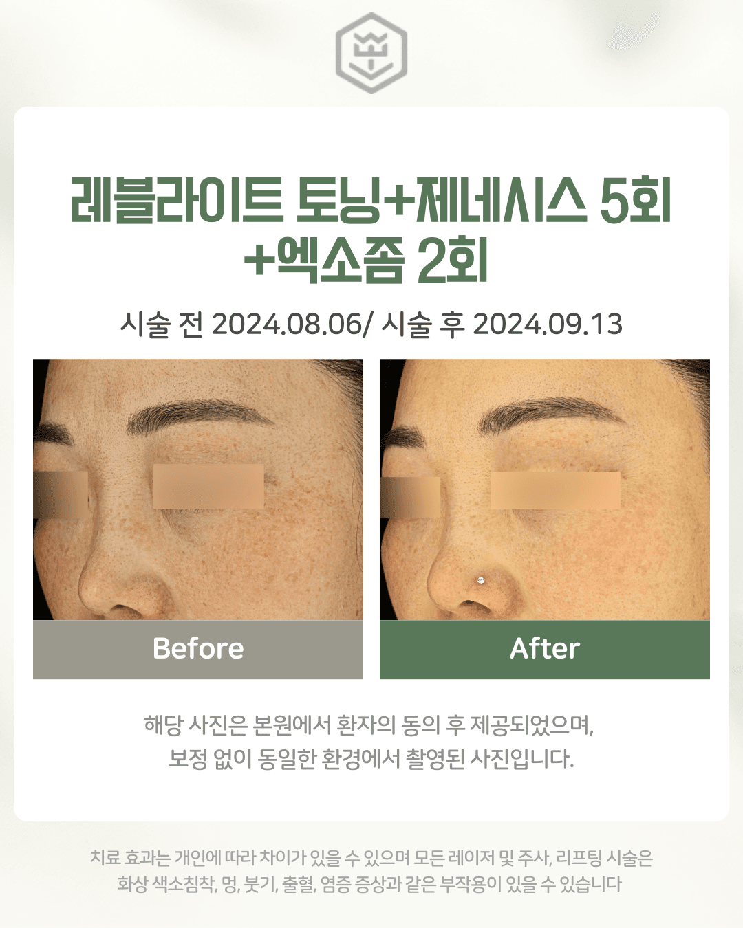 레블라이트+제네시스 5회+엑소좀 2회