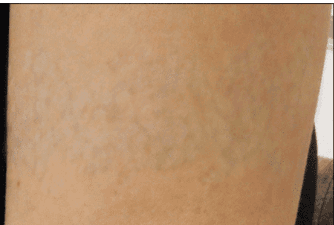 Healed skin after non-laser tattoo removal with no visible remaining ink.