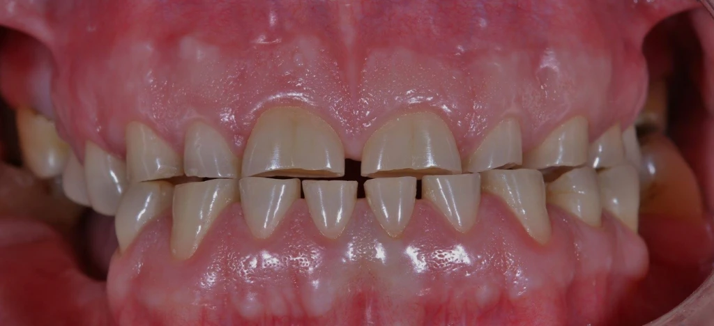 Tooth wear