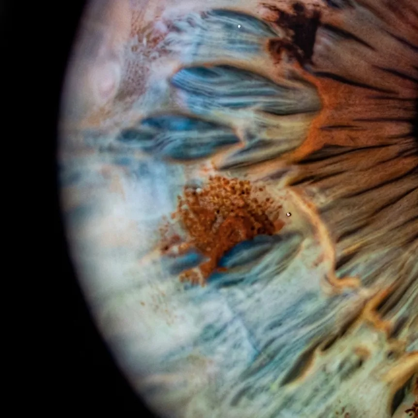 Fotografia macro di un’iride azzurra con pigmentazione centrale marrone e sfumature calde realizzata per IRIS DAY di Ottica Dentella ad Ancona. La fotografia mette in evidenza i dettagli microscopici, le fibre e i contrasti cromatici naturali dell’iride, creando un’immagine artistica unica e personale che racconta la straordinaria varietà di forme, colori e caratteristiche presenti in ogni sguardo.