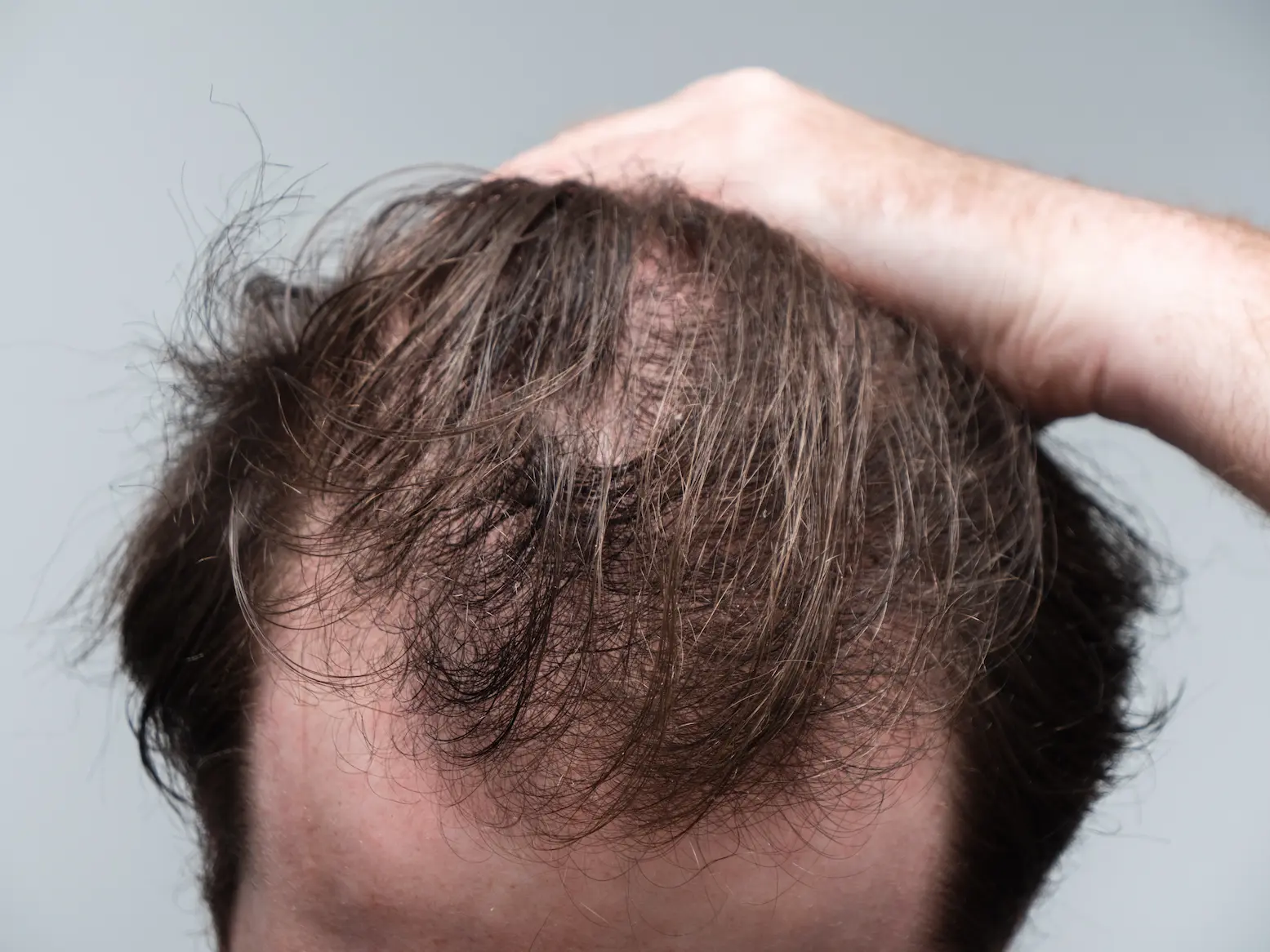 hair loss
