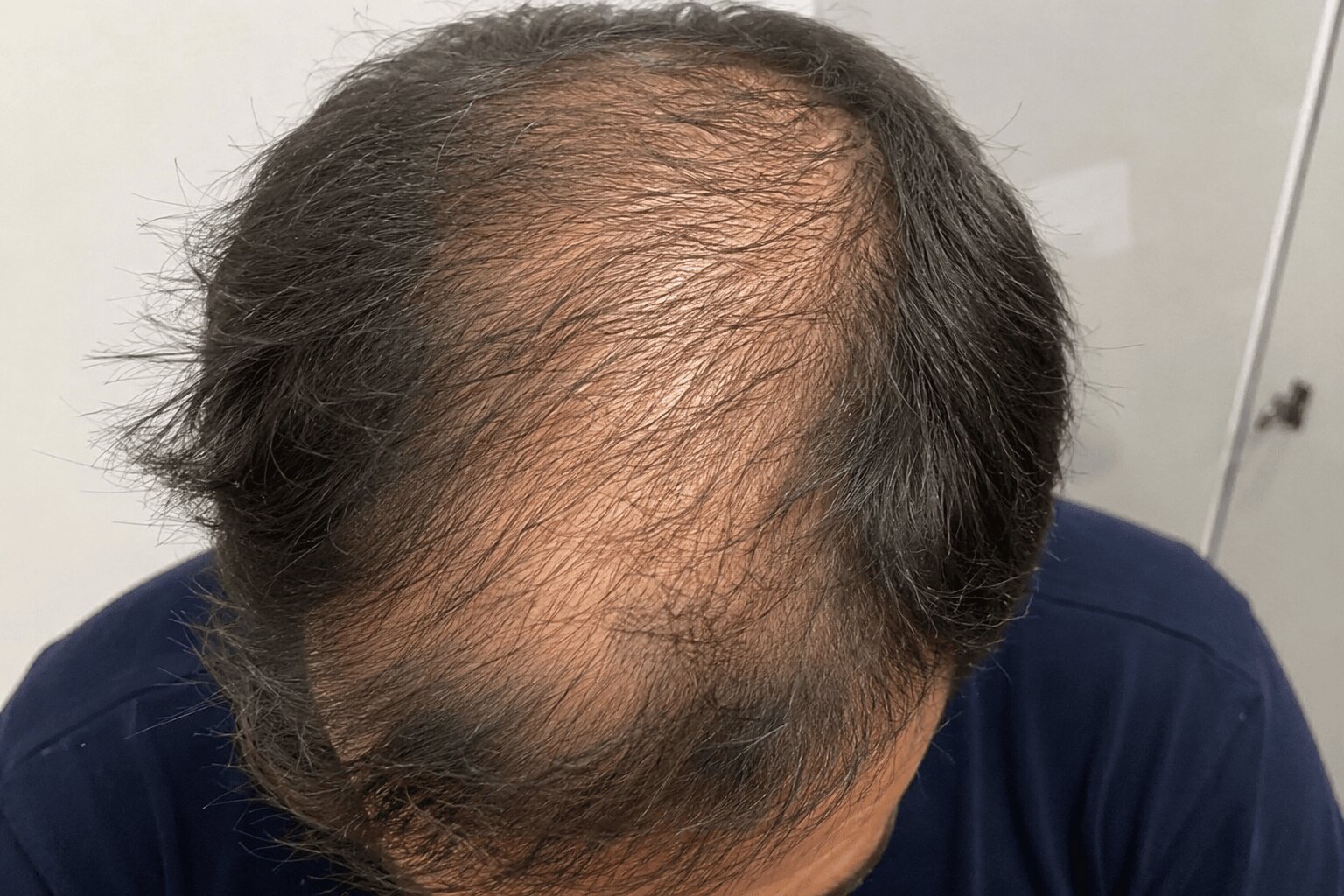 Man with a hair loss