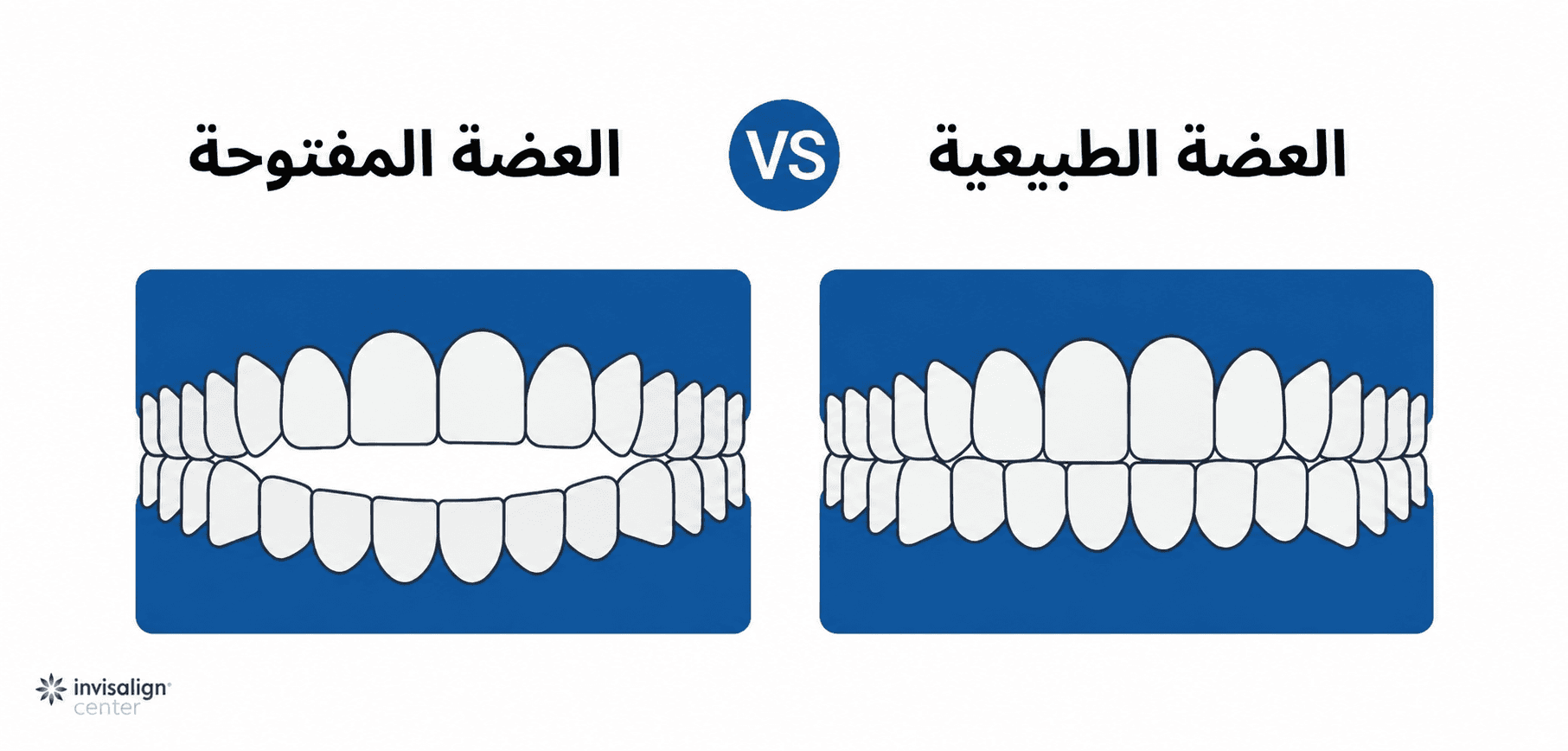 مقارنة طبية تبين الفرق بين إطباق الأسنان الطبيعي وحالة العضة المفتوحة، مع ظهور مسافة واضحة وفاصل بين الأسنان الأمامية