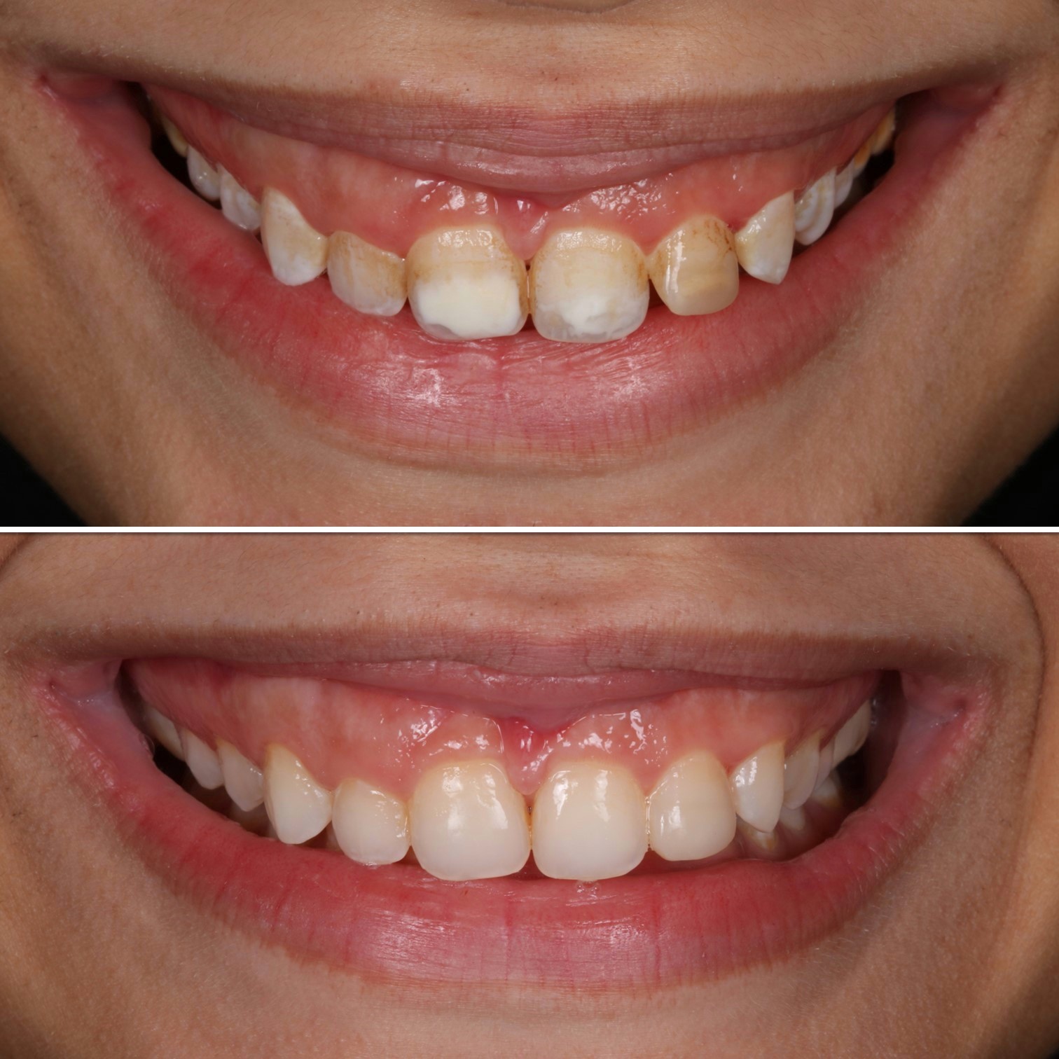 Fotos antes e depois de um sorriso.