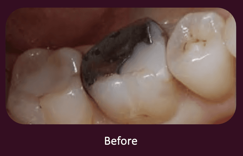 Teeth Implants