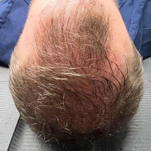 Before exosome PDRN therapy hair treatment at The Vancouver Aesthetician — visible male pattern balding and significant hair thinning