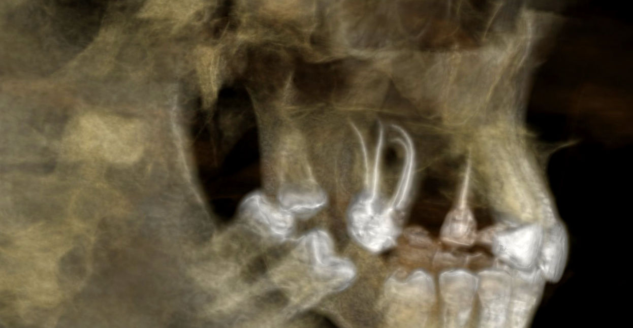 CBCT snímka ošetrených komplikovaných koreňových kanálikov