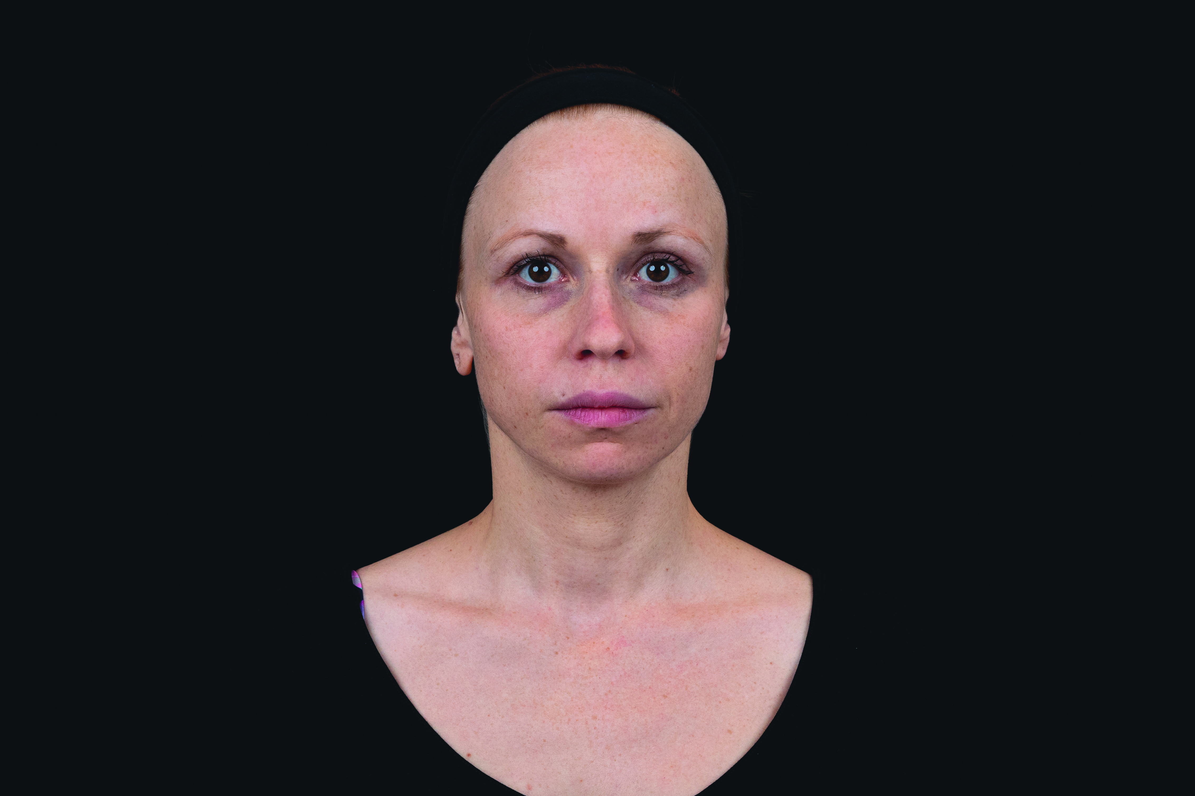 Female patient after Saypha Volume Lidocaine dermal filler treatment front view