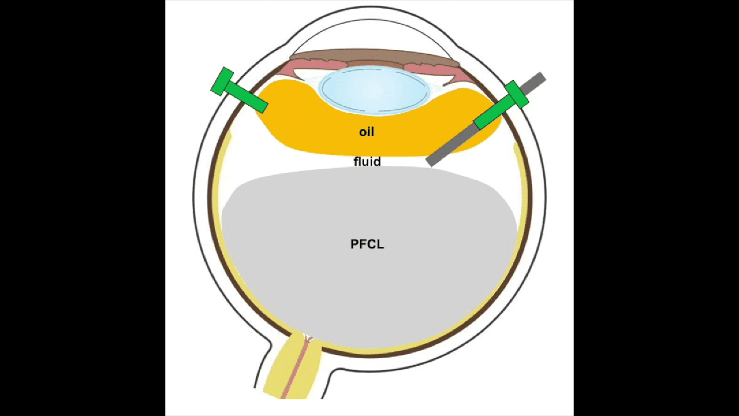 Diagram of an eye showing the use of PFCL and fluid for surgical procedures in retinal treatments.