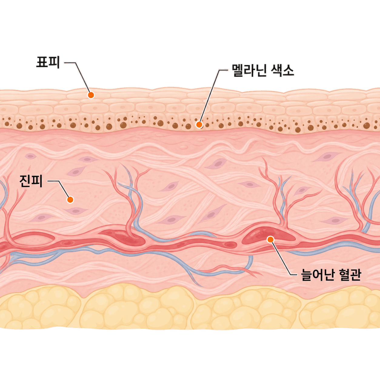 기미는 표피 아래 색소에 진피의 늘어난 혈관이 함께 있는 경우가 있어요