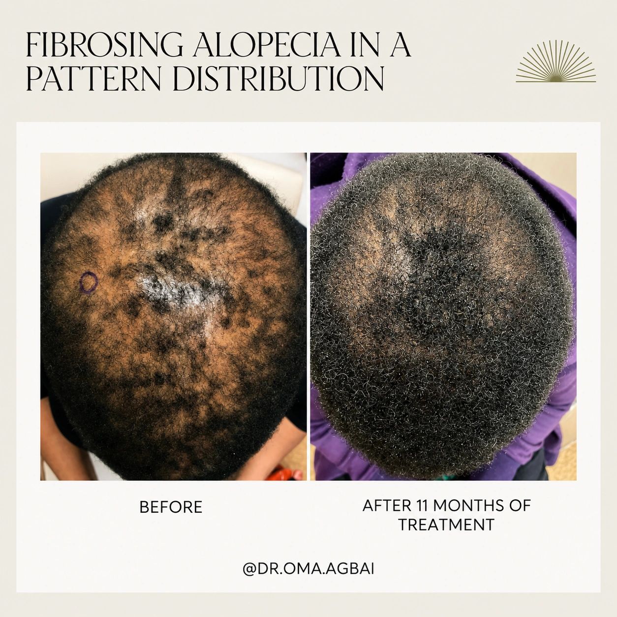 Fibrosing alopecia in a pattern distribution: before treatment on the left; after 11 months on the right.