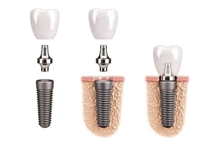 Fogászati implantátum (műgyökér beültetés)