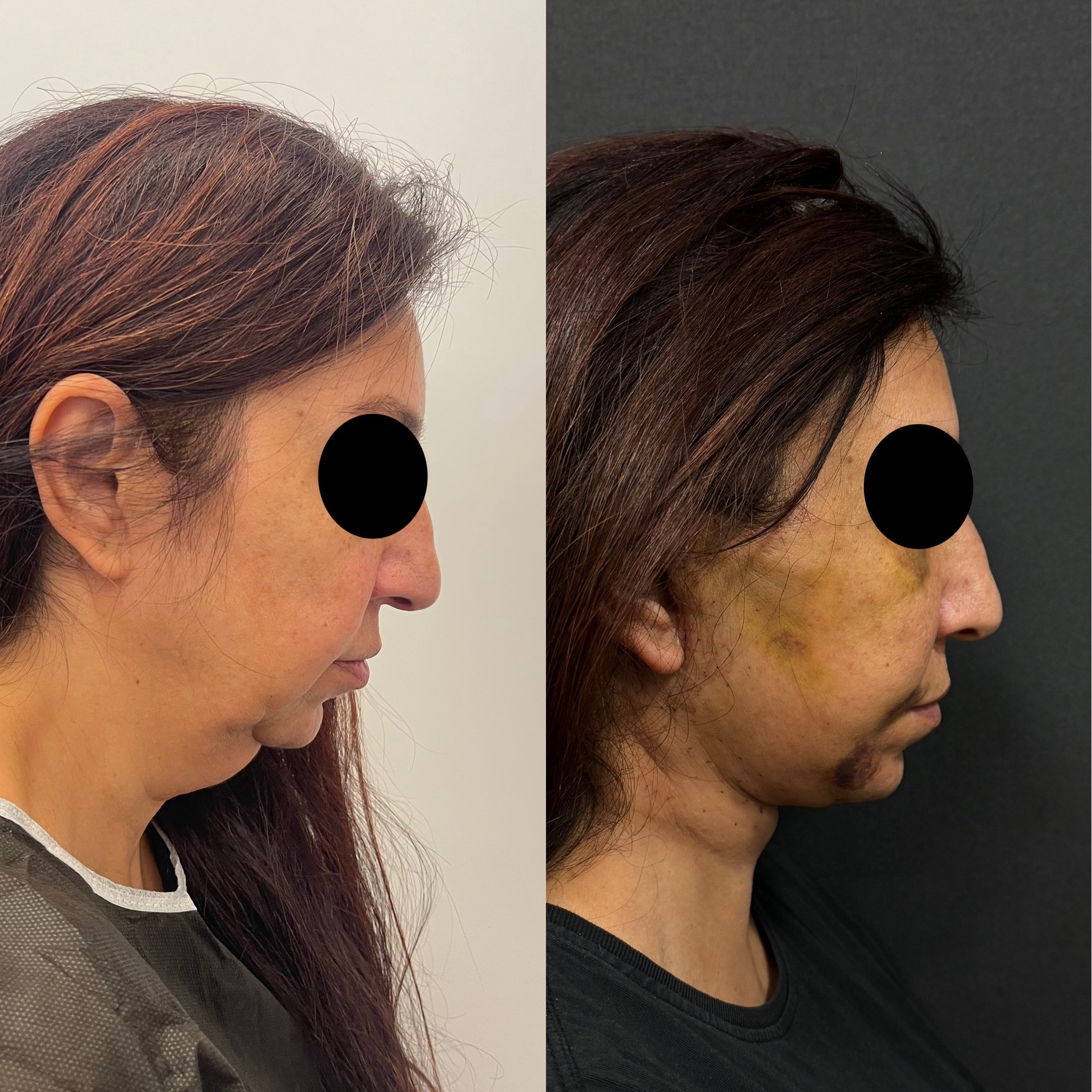 turkey neck deformity neck lift before after right side view