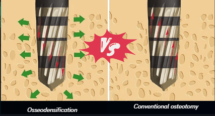 Osseodensification Vs Conventional osteotomy image