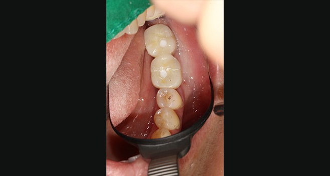 36,37보철 셋팅