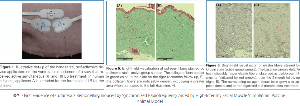 Emface treatment histology showing collagen and elastin remodeling