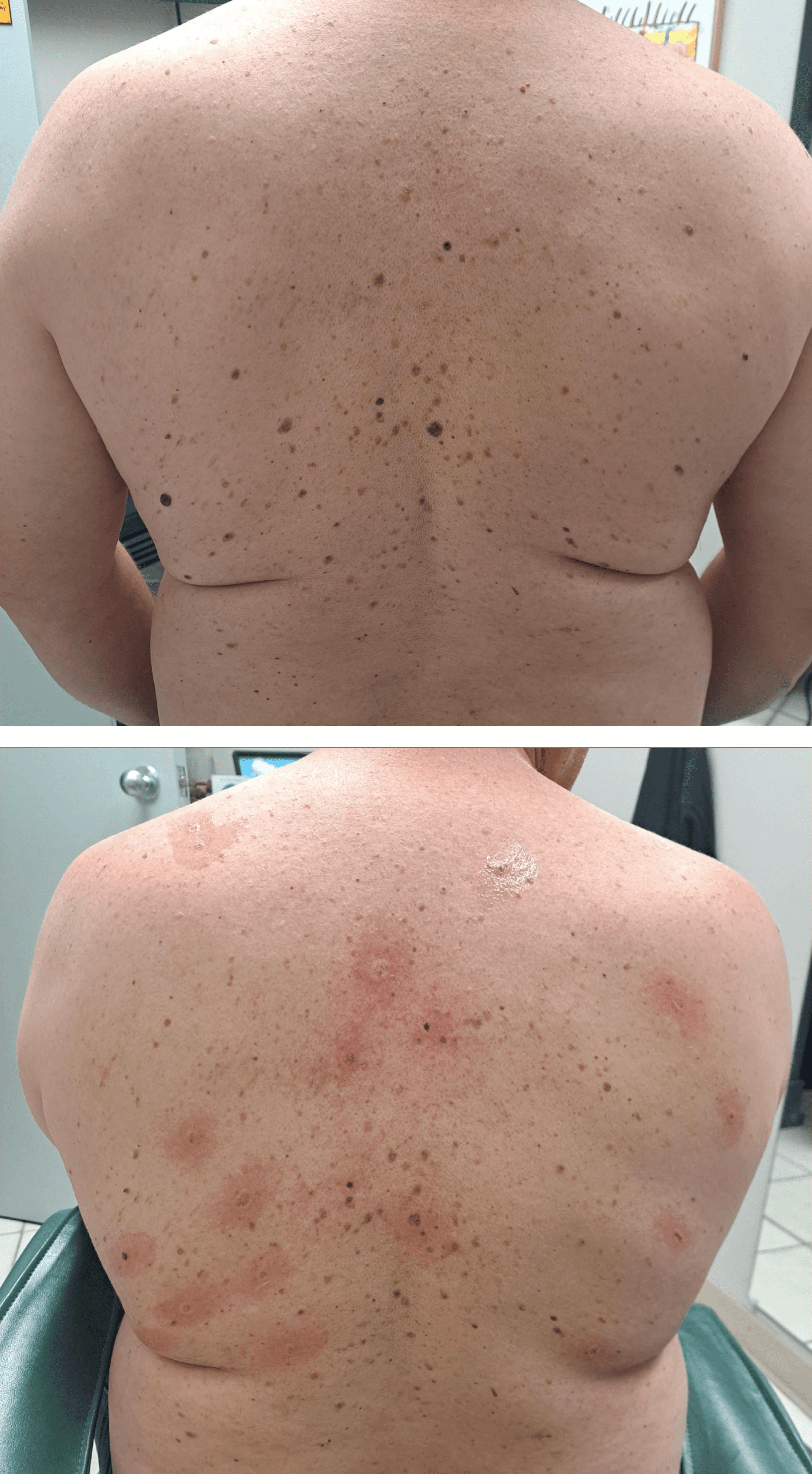 Cherry Angioma Removal Lam probe