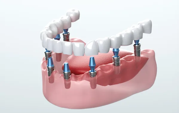 smyrna dental implants