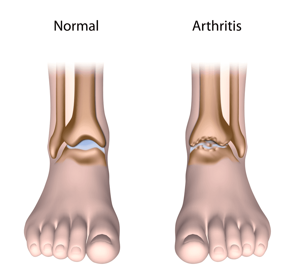 illustration for arthritis of the foot & ankle