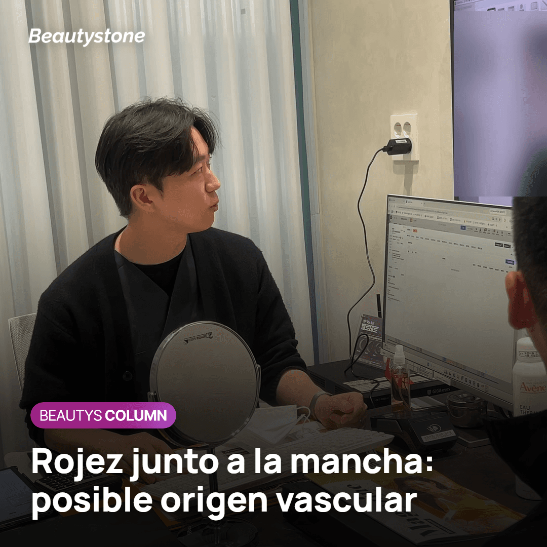Rojez alrededor del melasma que sugiere un componente vascular