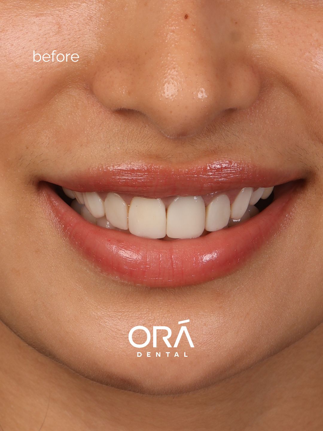 Close-up before photo showing overly long discolored composite veneers restricting lip movement before EMax treatment at Ora Dental