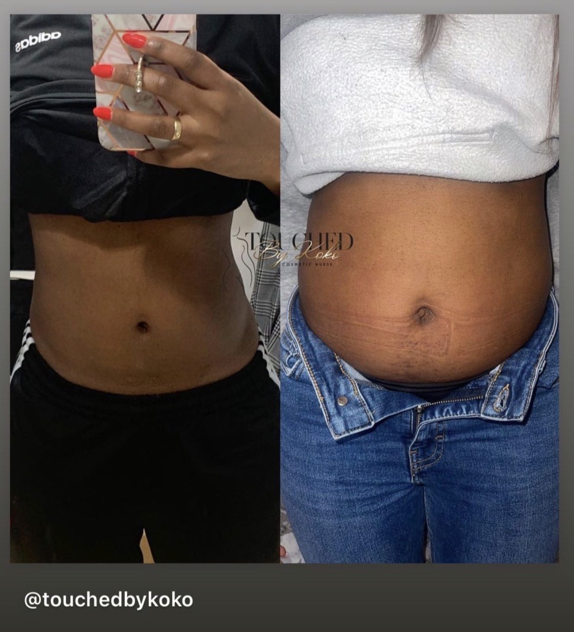 Fat dissoliving slim