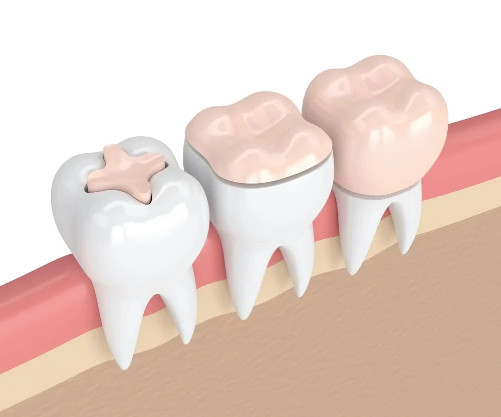 dental crowns and fillings