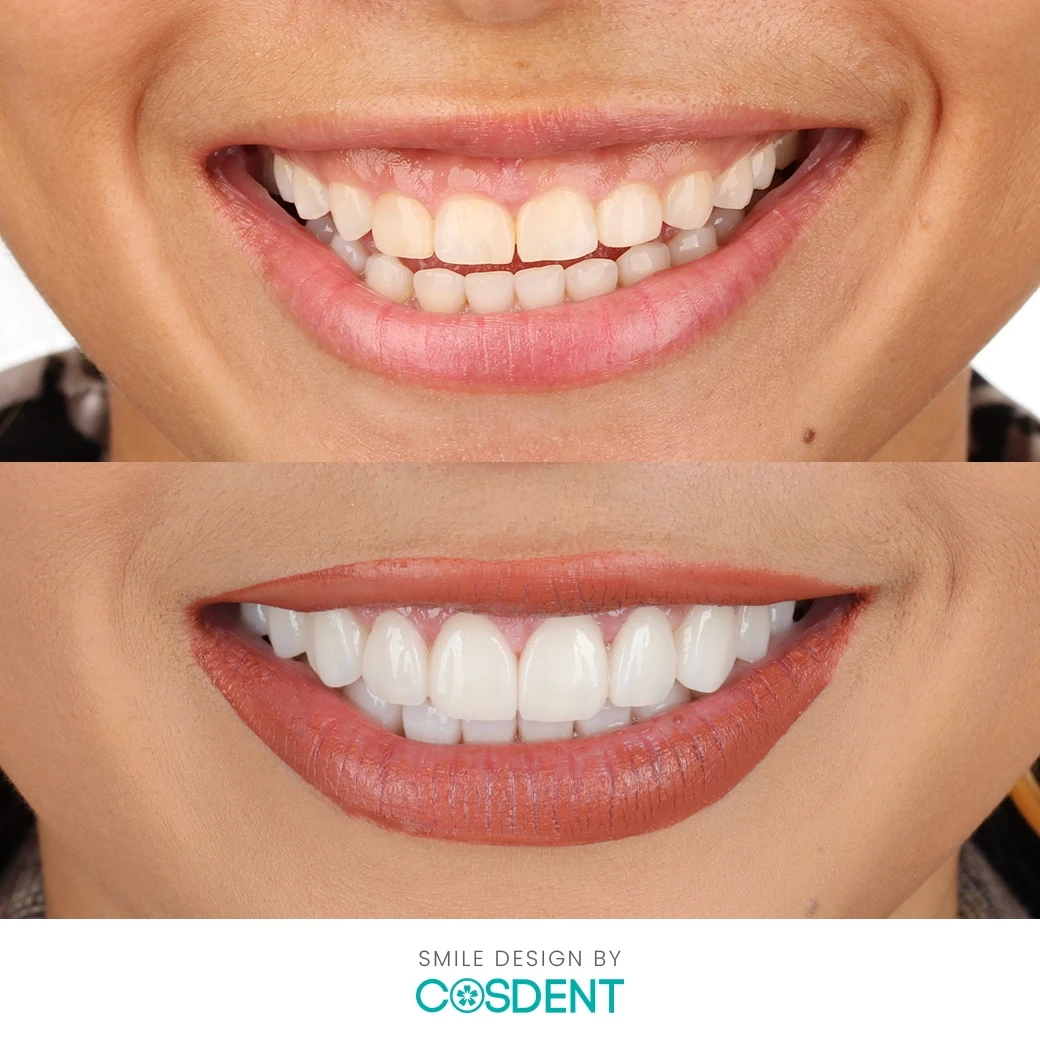 รีวิวออกแบบรอยยิ้ม ที่ cosdent smile design