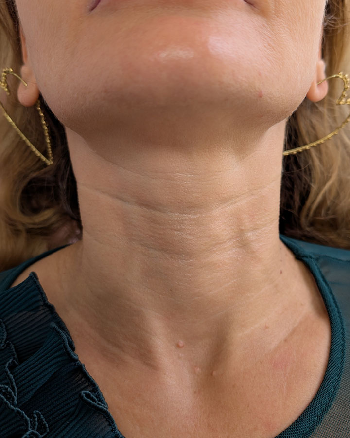 Vrásky na krku a strata elasticity pokožky pred kolagénovou stimuláciou