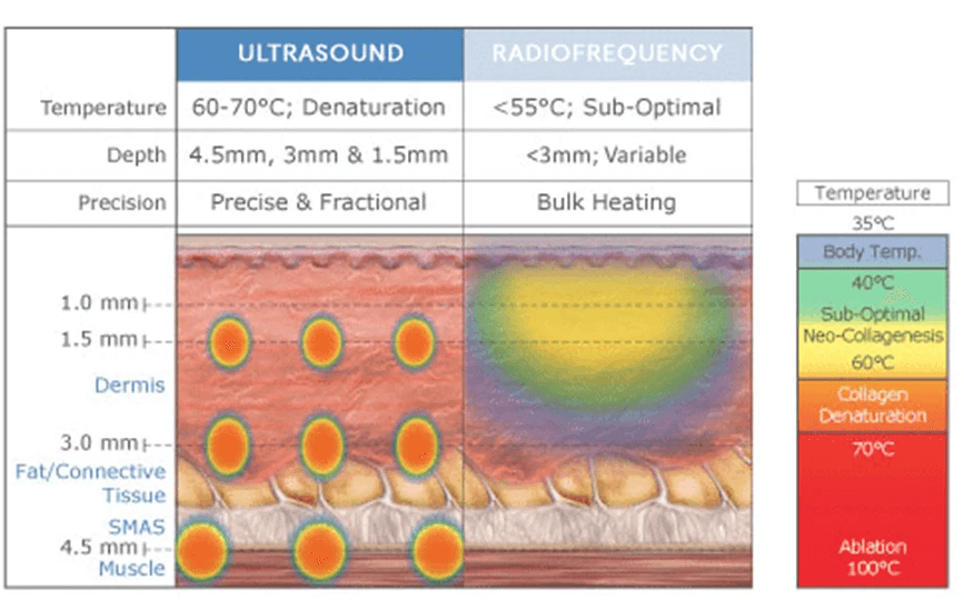 Ultrasound vs radiofrequency skin treatment depth comparison chart