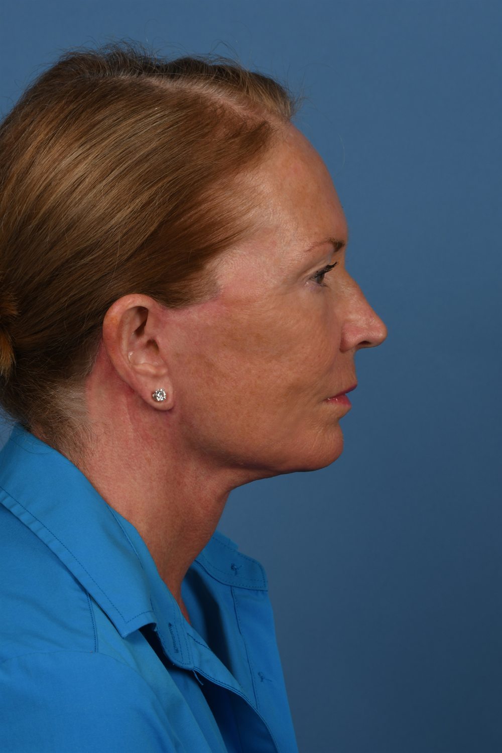 Facelift patient after surgery, profile, right side