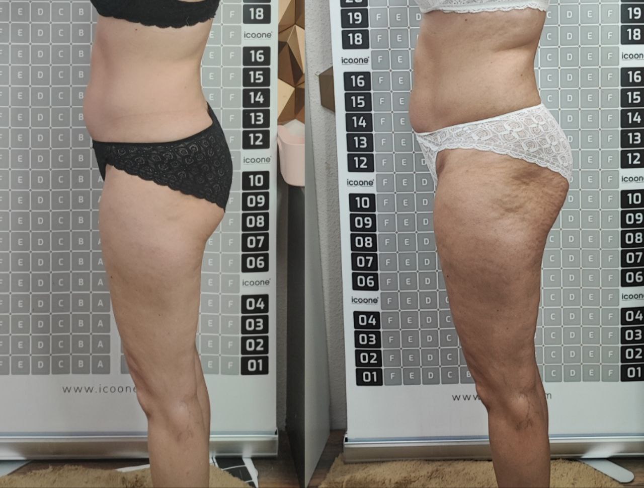 Photos of the results before and after laser body rejuvenation