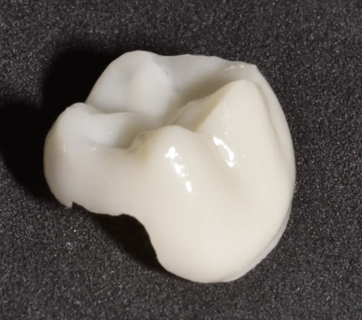 3D-gedruckte Onlays, bereit für die Zementierung