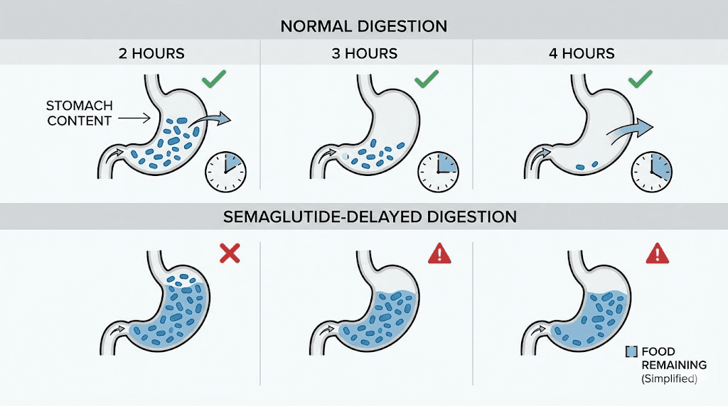 Semaglutide delayed gastric emptying comparison diagram showing food retention at different timepoints