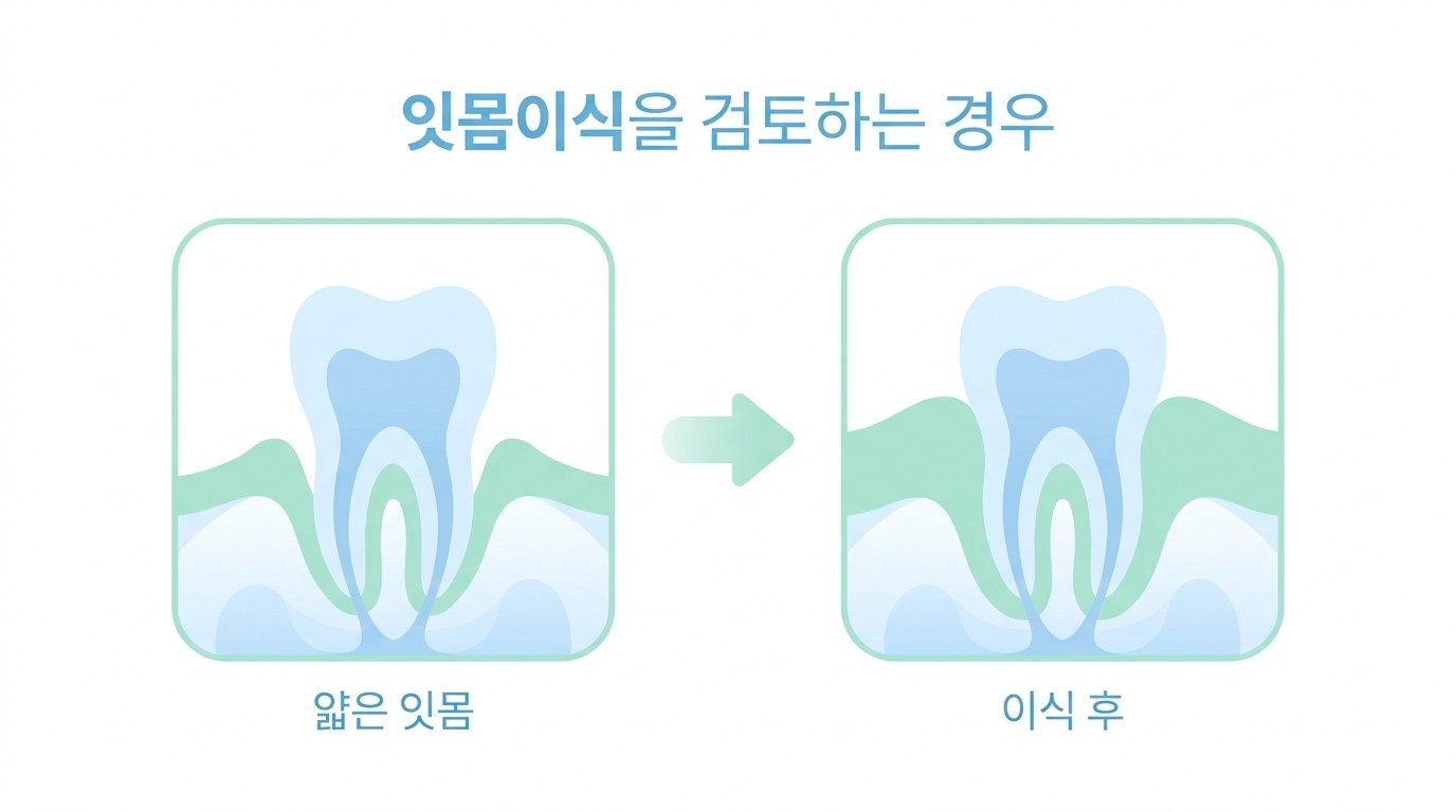 얇은 잇몸과 잇몸이식 후를 비교한 일러스트
