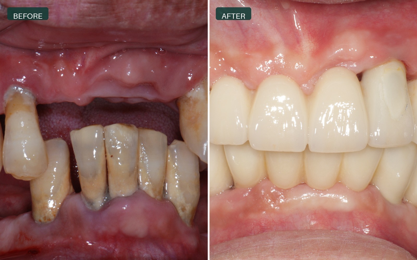 Dental implant case 01 before and after