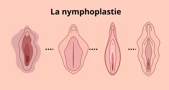 illustration d'une La nymphoplastie