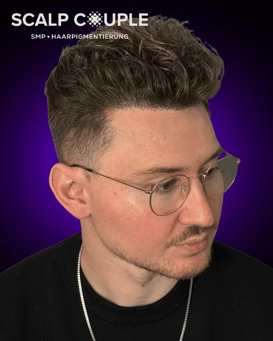 Haarpigmentierung Mann Vorher Nachher – Zone 1–2 Haaransatz & Geheimratsecken | Scalp Couple