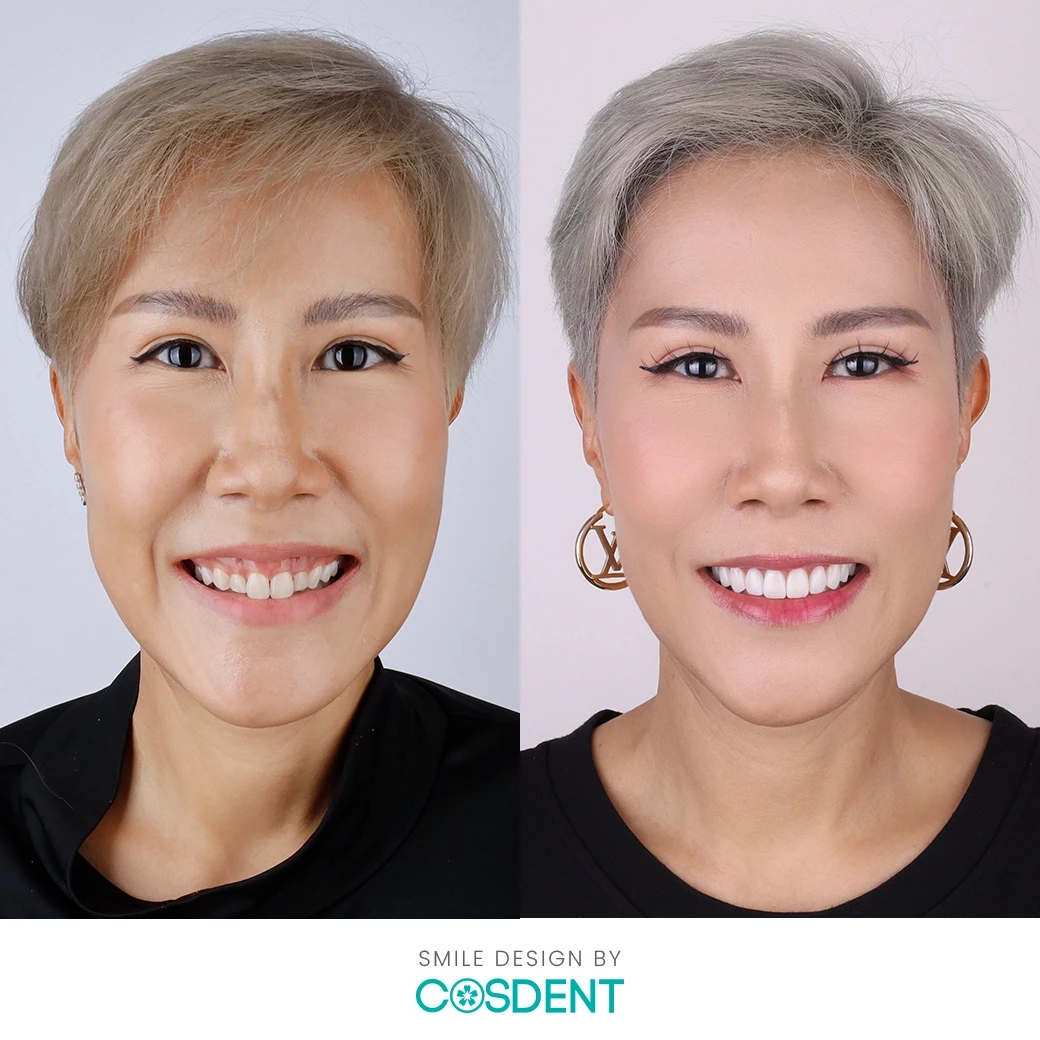 รีวิวออกแบบรอยยิ้ม ที่ cosdent smile design