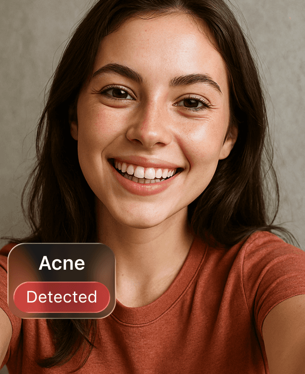 AI Acne Detection
