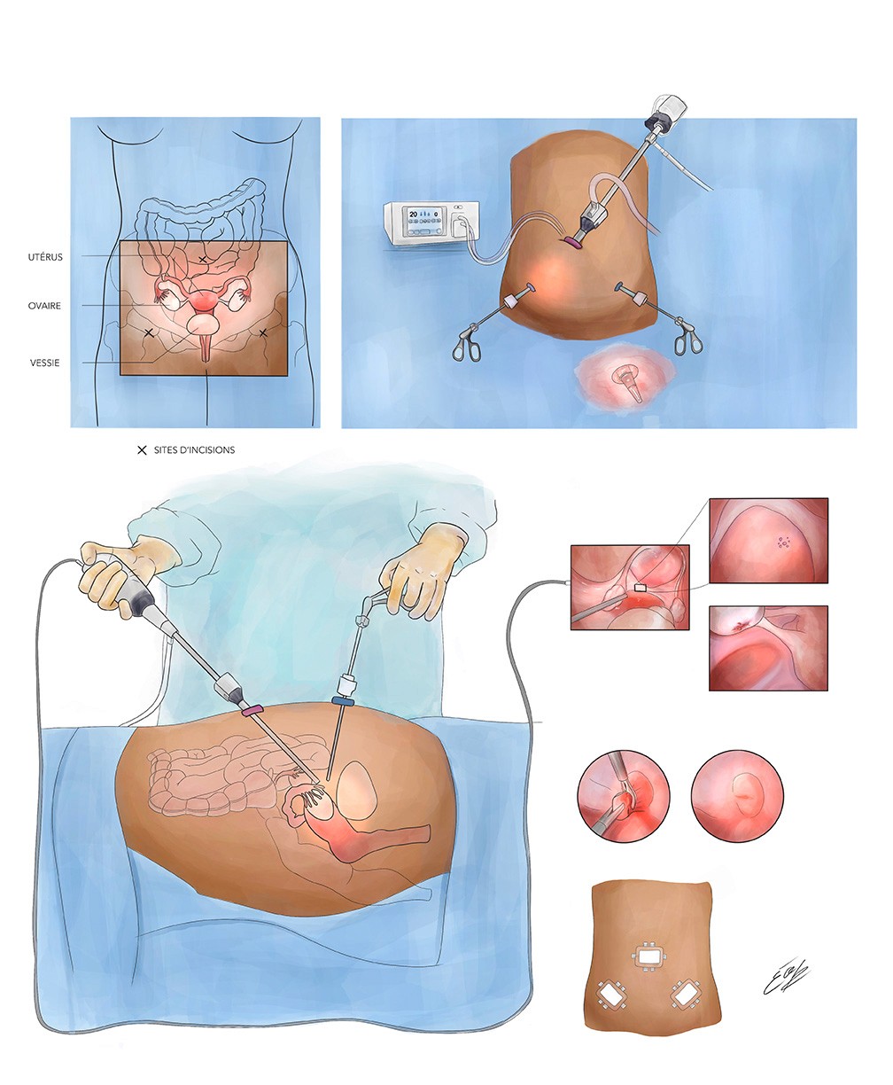 Image de l'illustration d'Élodie Ouellet-Belleau d'une laparoscopie pour l'endométriose. Coin supérieur gauche montrant les structures anatomiques. Coin supérieur droite montre la préparation et l'insertion des intruments chirurgicaux. Le bas de l'illustration montre un ou une chirurgienne et les lésions d'endométriose qui sont excisées. Le tout est finalisé à l'aide de pansements.