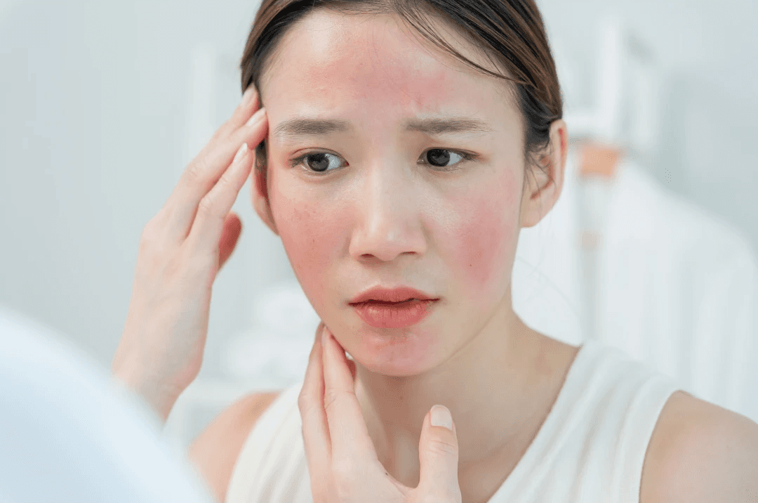 A woman with a distinct malar butterfly rash across her nose and cheeks—a primary symptom of Systemic Lupus Erythematosus (SLE)—sits at a sunlit table wearing a wide-brimmed hat for protection against photosensitivity. Bottles of anti-inflammatory medication and sunscreen, along with a symptom journal, rest beside her cup of tea, illustrating daily life with an autoimmune condition.