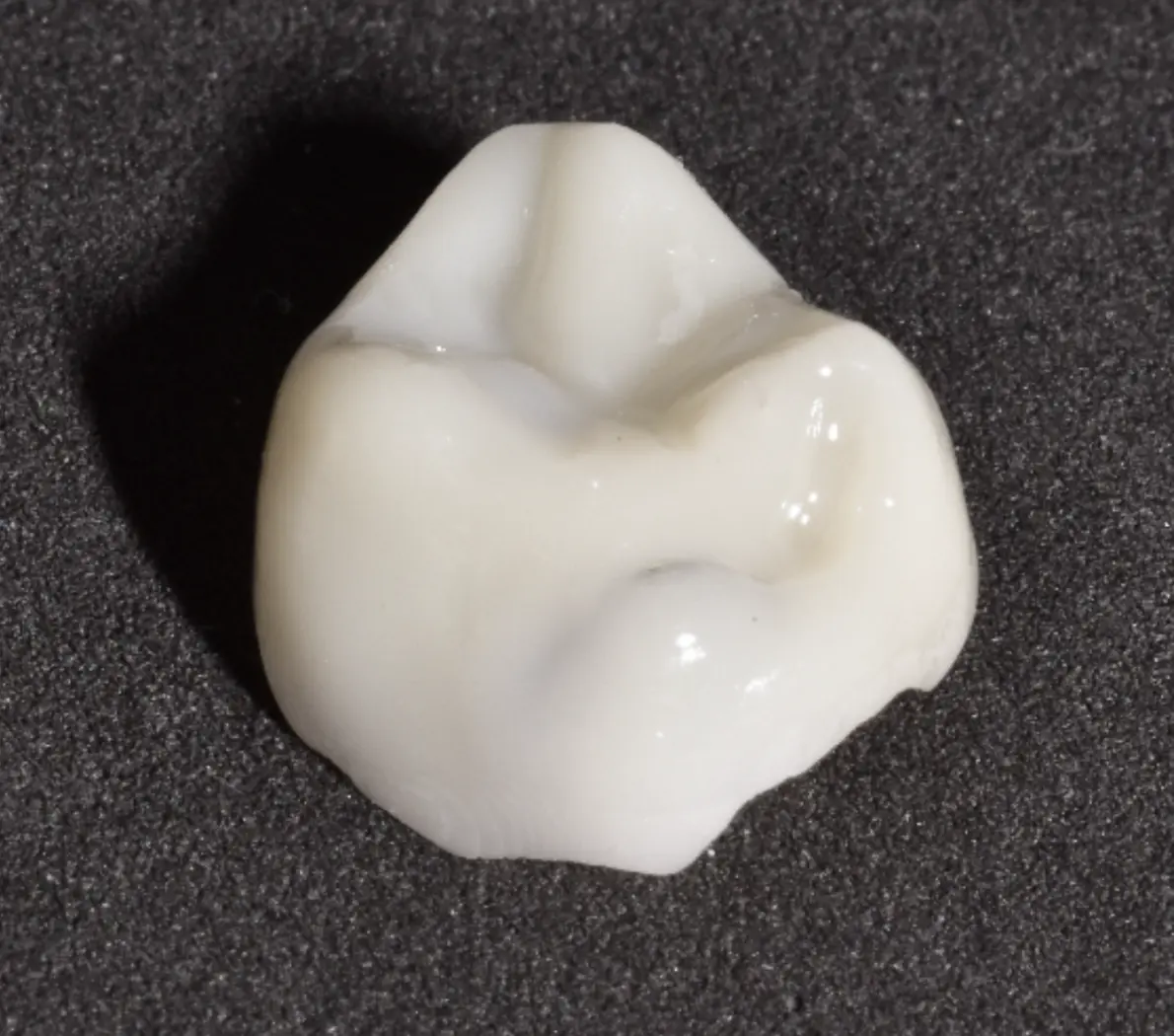 3D-gedruckte Onlays, bereit für die Zementierung