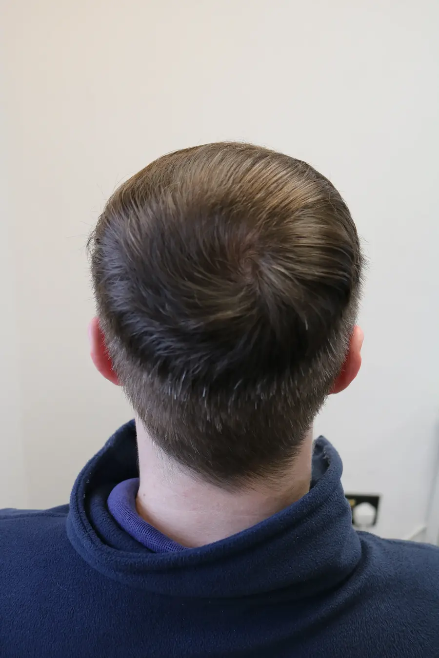 After hair transplant – David's FUE Crown Transplant