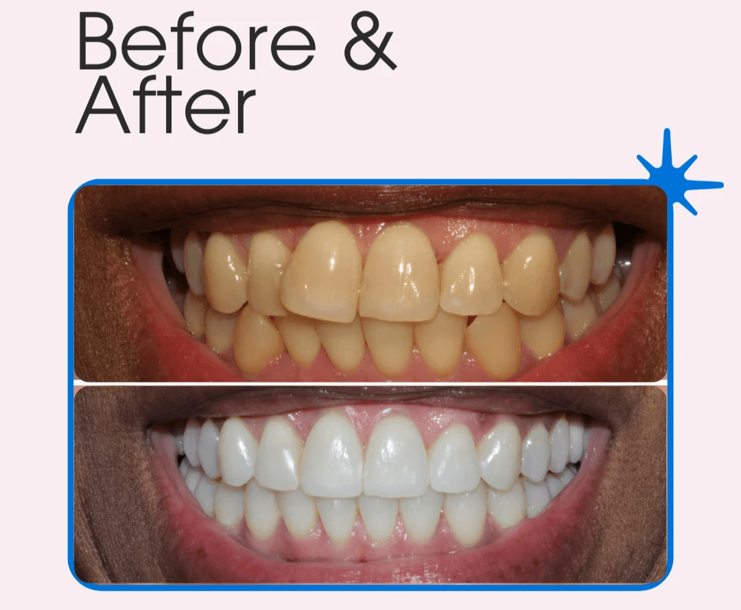 Teeth Whitening Before and After