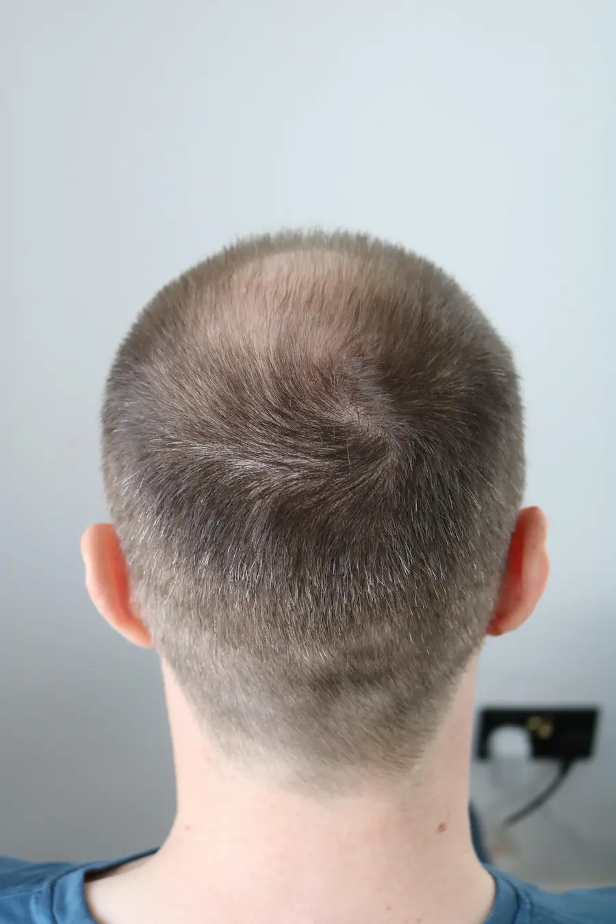 Before hair transplant – David's FUE Crown Transplant